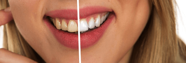 teeth whitening parramatta - zoom teeth whitening