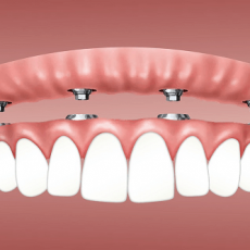 Dental Implants Parramatta – A Smile To Be Proud Of
