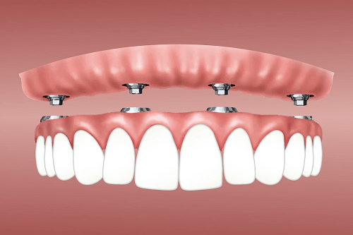 Dental Implants Parramatta NSW