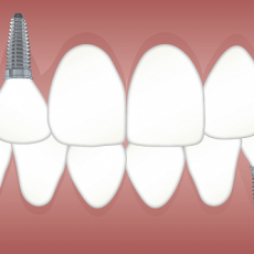 Tooth Replacement Parramatta – Change Your Life With Your Smile