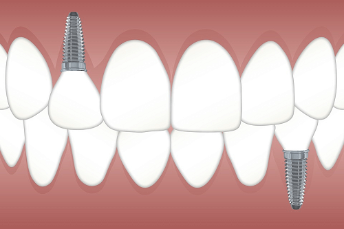 Tooth Replacement Parramatta NSW